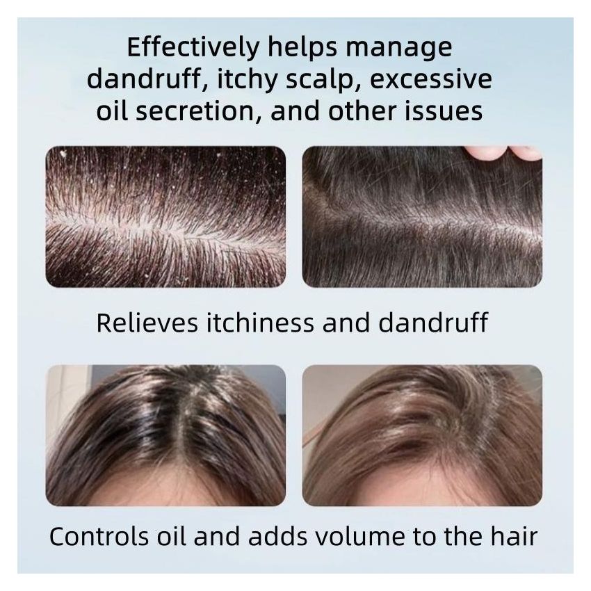 [buy 1 get 1 free] Selenium Disulfide Anti-Dandruff Shampoo 300ml – Oil Control, Itch Relief, Scalp Health with Natural Ingredients